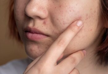 espremer espinhas pode causar infeccoes e em casos raros levar a internacao