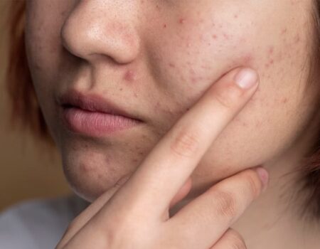 espremer espinhas pode causar infeccoes e em casos raros levar a internacao